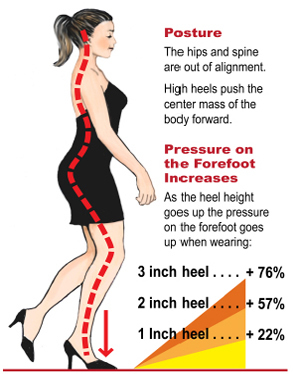 Size of Women’s High Heels causes Morton’s Neuroma